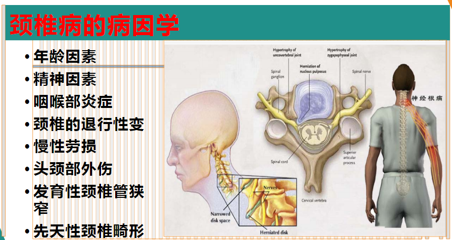 最新颈椎病治疗方法的研究与应用进展